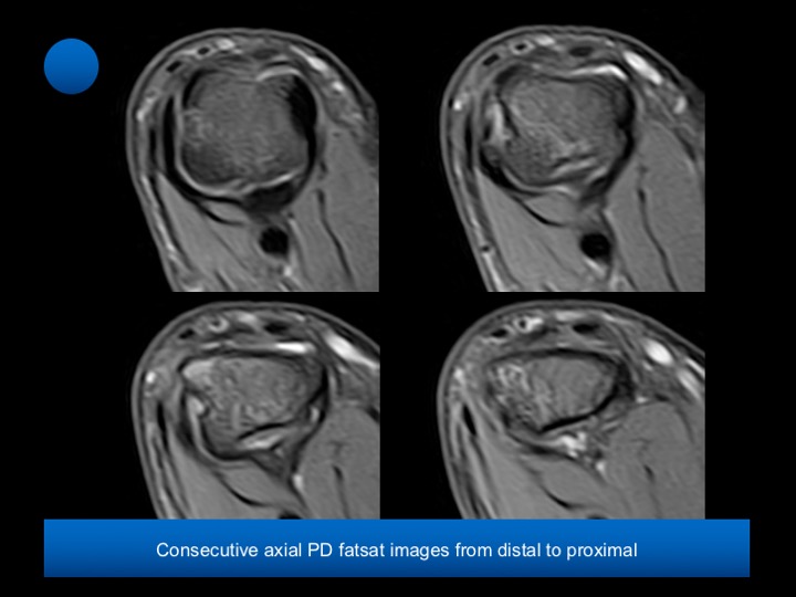 Figure 2 for case Complete proximal tear of the radial collateral ligament of the MPJ of the thumb